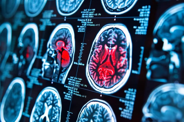 They also found that the more time that had passed since the concussion occurred, the more likely people were to have higher levels of iron accumulation in areas of the brain. Credit: Neuroscience News