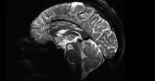 An image of a human brain captured with the new Iseult MRI machine at a power of 11.7 Teslas, showing the level of detail possible