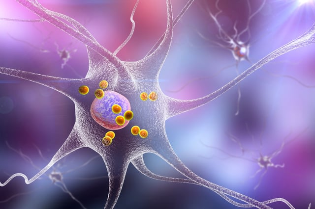 Parkinson's disease. 3D illustration showing neurons containing Lewy bodies (small red spheres) which are deposits of proteins accumulated in brain cells that cause their progressive degeneration