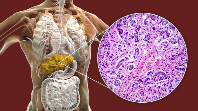 A computer illustration of a human body, showing the liver inside the abdomen in yellow. A micrograph of a section of a human liver is included, stained in pinks and purples, showing cirrhosis or scarring.