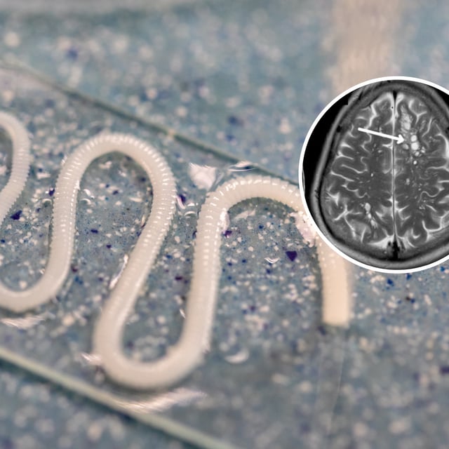 Photo of a tapeworm with inset of brain scan showing a cystic lesion where the tapeworm larvae had lodged in the patient's brain.