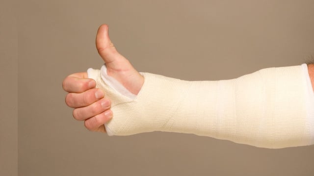 fracture