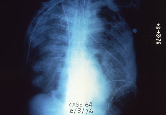 Legionnaire's disease x-ray