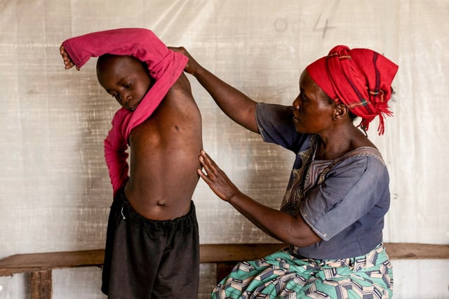 Fideline Kiza Kasao, right, checks the progress of her son Kito Balume after recovering from mpox in Goma, North Kivu province, Democratic Republic of the Congo on July 18, 2024.