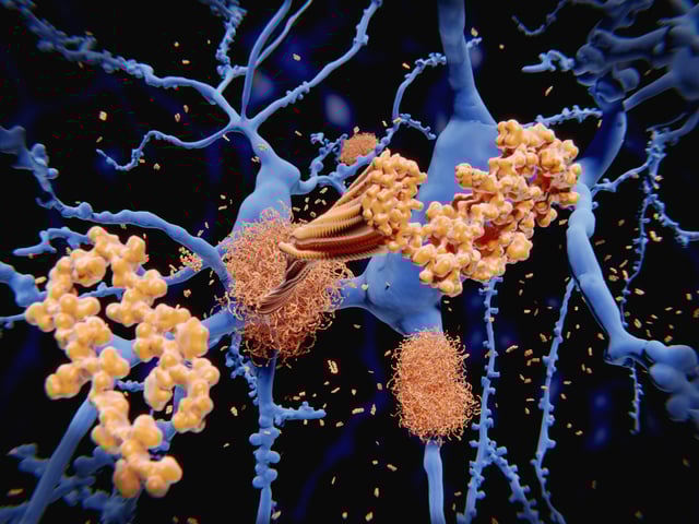 Alzheimer's