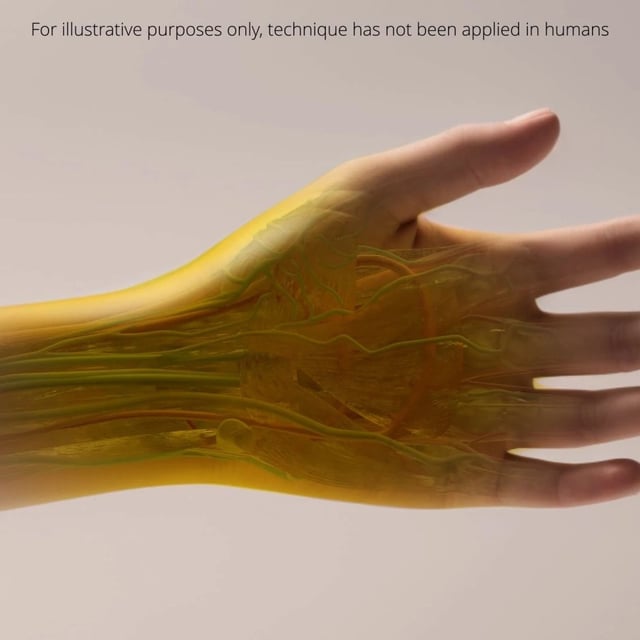 Artist's impression of the yellow dye rendering human skin transparent. This is just an illustration and the technique has not yet been trialed on human skin.